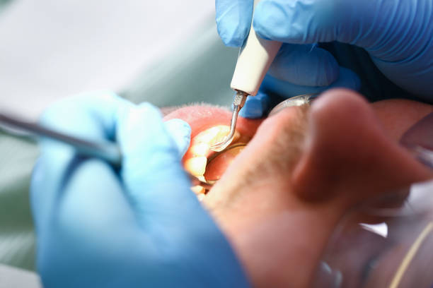 Best Emergency Dentist for Lost Fillings or Crowns in Unionville, TN